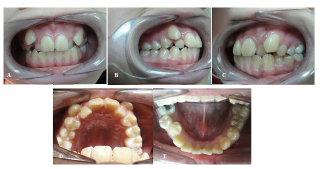 Perawatan Ortodontik Inkonvensional Gigi Atas Berjejal Dengan Keberadaan Kista Cobra Dental Indonesia