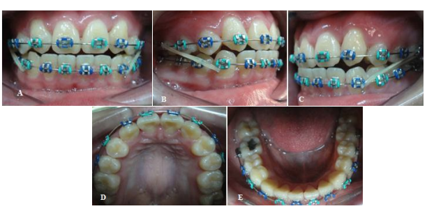 Perawatan Ortodontik Inkonvensional Gigi Atas Berjejal Dengan Keberadaan Kista