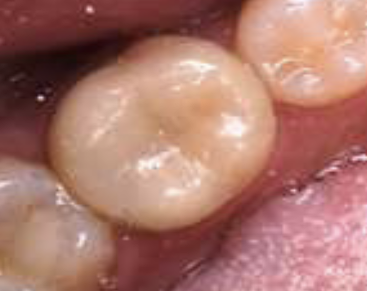 Perawatan Saluran Akar pada Gigi Molar Pertama Kanan Mandibula dengan Pulpitis Ireversibel Simtomatik