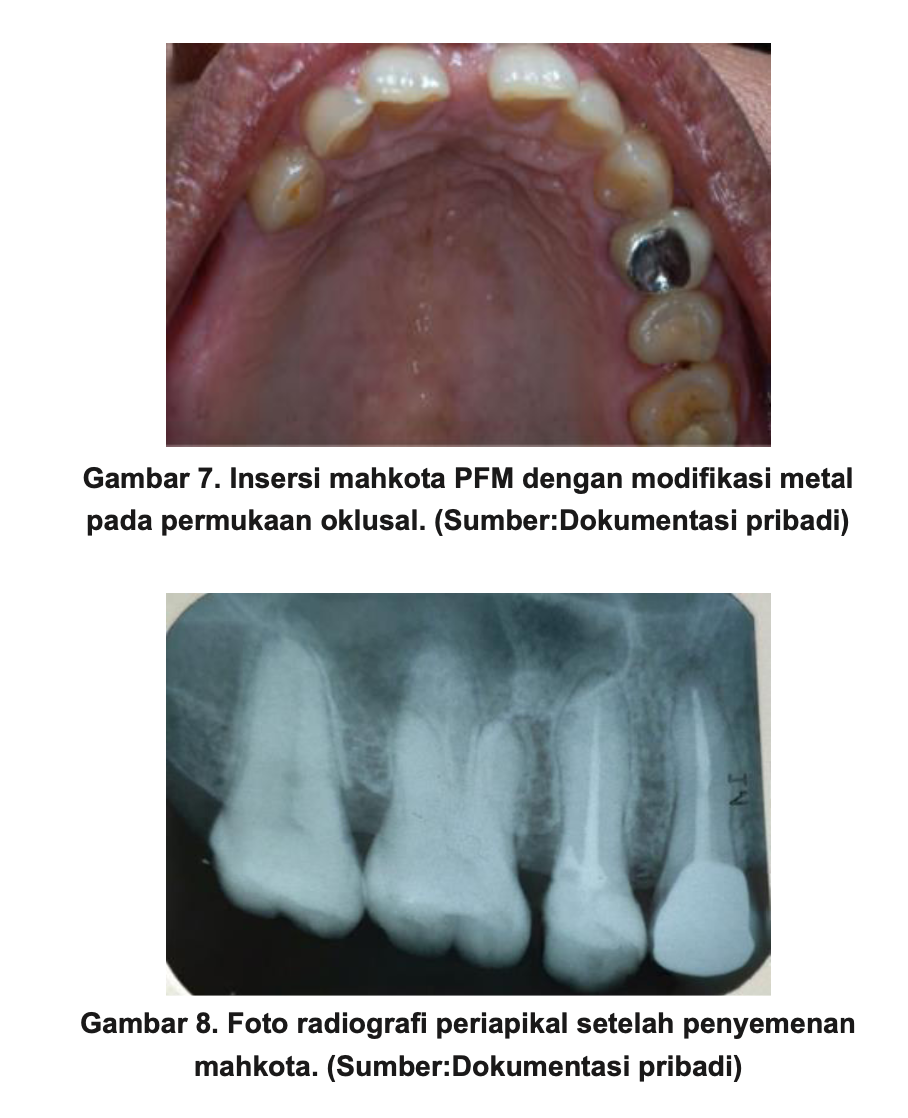 Modifikasi Mahkota Metal Porselen pada Restorasi Paska Perawatan Endodontik Gigi Premolar Atas Kanan