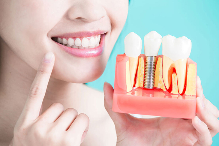 Solusi Implan Gigi yang Dipersonalisasi