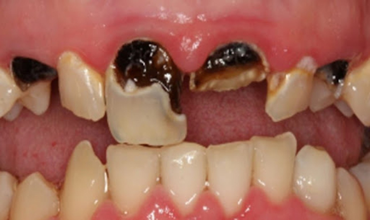 Cara Mencegah dan Mengobati Karies Gigi pada Anak