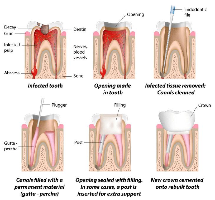 Seberapa Penting Perawatan Saluran Akar Gigi ?