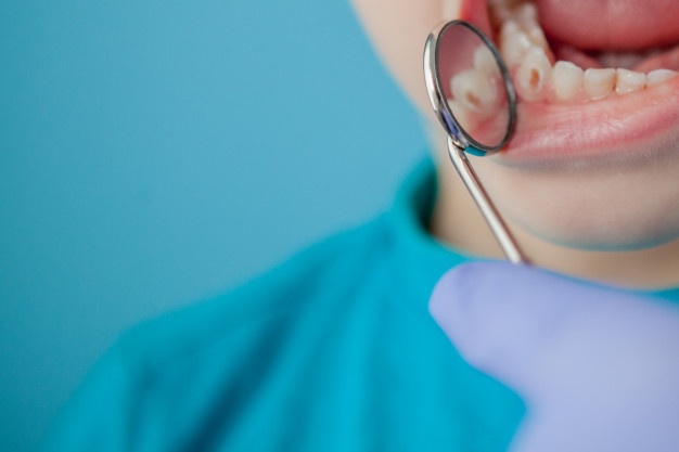 5 Tips Mencegah Karies Gigi pada Anak