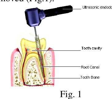 PDF] Contributions regarding FEM for an ultrasonic endodontic device and his appliance in the root canal treatments | Semantic Scholar